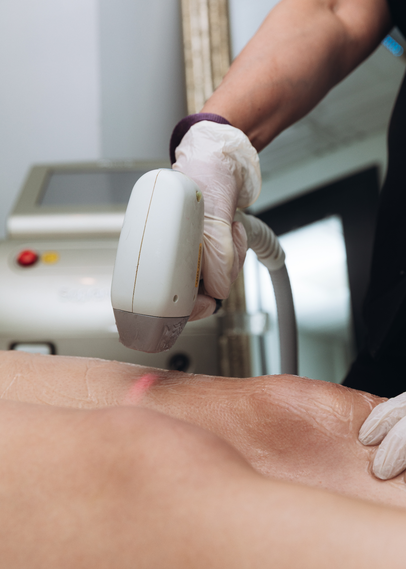 Leg laser hair removal with Soprano ICE at HBL Spa